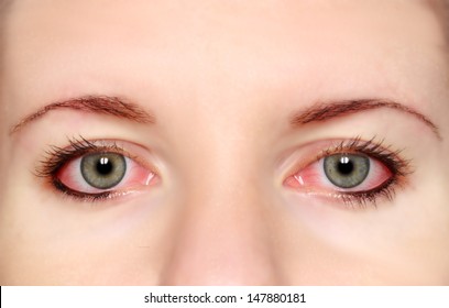 Closeup of irritated red bloodshot eye - conjunctivitis