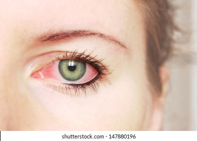 Closeup of irritated red bloodshot eye - conjunctivitis