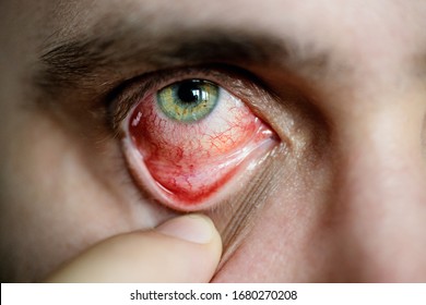 Download Bloodshot Eyeball Images Stock Photos Vectors Shutterstock