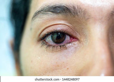 Closeup  of irritated red eye of a patient with human conjunctivitis or infected red bloodshot eye