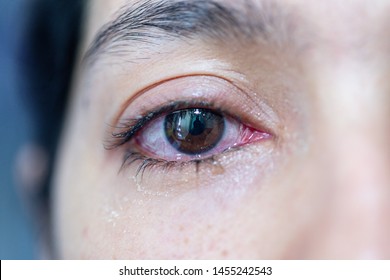 Closeup  of irritated red eye of a patient with human conjunctivitis or infected red bloodshot eye
