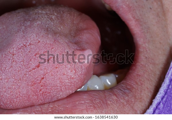 470 Fibroma Images, Stock Photos & Vectors | Shutterstock