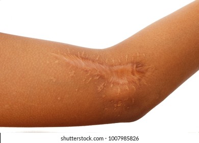 Closeup keloid scar on The boy arm isolated on white background.with copy space.