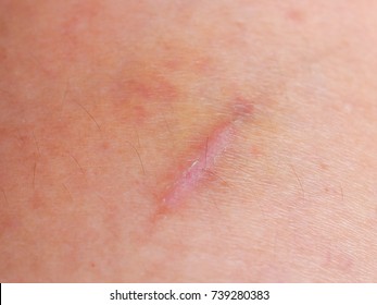 skin scar keloid