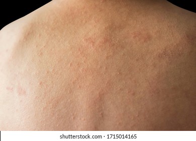 Closeup Kid Back With Eczema Atopic Dermatitis Skin Isolated On Black Background. Cow's Milk Protein Allergy In Children. Healthy Insurance And Child Disease Concept. Soft Focus At Middle Back Rash.