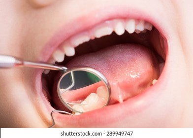 Closeup of kid or child mouth at dentist. Dental mirror and teeth reflection