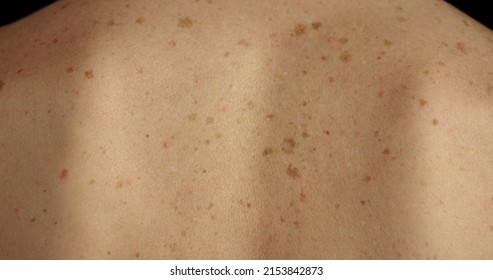 Close-up of large rashes or smallpox on the skin of an adult male. Pigmented spots on the back of a man. Skin of a man with moles. Acne. - Shutterstock ID 2153842873