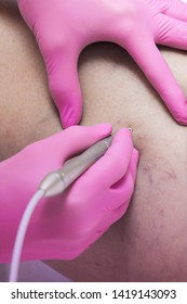 Closeup Of Laser Capillary Removal Procedure In Medical Clinic