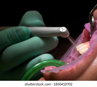 Closeup Of Laser Etching Teeth Procedure For Direct Bonding Of
Orthodontic Appliance