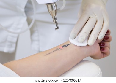 Close-up of laser tattoo removal from woman hand.