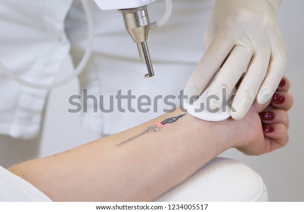 Close-up of\
laser tattoo removal from woman\
hand.
