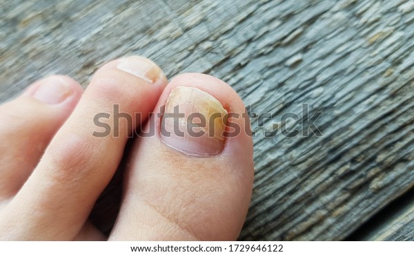 Close-up of a leg with a fungus on nails on a wooden
background. Onycholysis: exfoliation of the nail from the nail
bed.