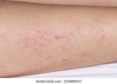 Close-up of the leg of a girl suffering from varicose veins and enlarged capillaries. Veins in evidence. Concept of skin blemishes and danger of thrombosis and phlebitis