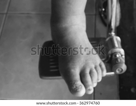 Closeup of legs elderly patient woman on wheelchair black and white blur .