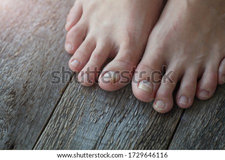 Close-up of legs with fungus on nails on wooden background. Onycholysis: exfoliation of the nail from the nail bed.
