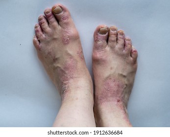 psoriasis feet