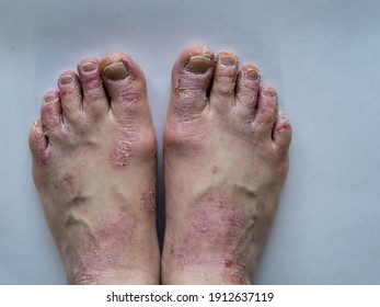 psoriasis feet