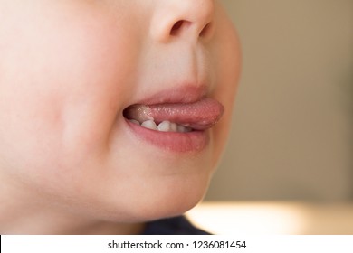 Close-up Of Little Kid Boy With Aphtha Or Stomatitis Or Canker On Tongue In His Mouth