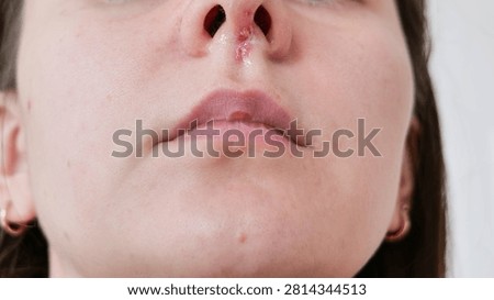 Close-up of the lower part of a face with ointment applied under the nose due to irritation from a cold. Healthcare concept illustrating respiratory illness, skin care, and recovery during seasonal