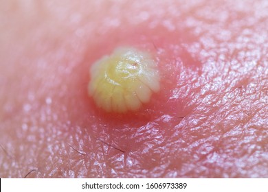 white pimple with puss