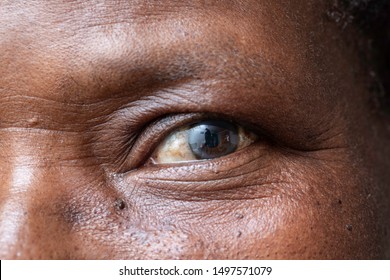 A Closeup And Macro View On The Eye Of An Elderly Black Woman, A Cloudy Film Is Seen Over The Iris, Symptomatic Of A Cataract, Natural Aging Of The Human Eyes.