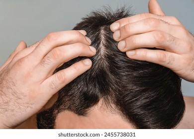 Closeup male dark hair. Head skin problems, receding hairline, alopecia, dandruff concept. Healthy treatment for seborrhea, psoriasis, dermatitis. Shampoo conditioner advertisement - Powered by Shutterstock