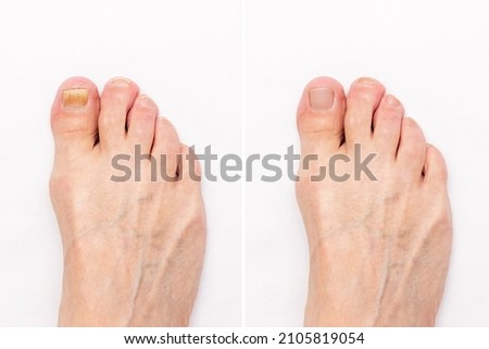Close-up of a male foot with yellow ugly fungus on toenails and healthy nails before and after treatmet isolated on a white background. Fungal nail infection.
Advanced stage of disease. Top view