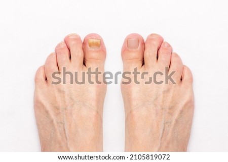 Close-up of a male foot with yellow ugly fungus on toenails and healed nails before and after treatmet isolated on a white background. Fungal nail infection.
Advanced stage of disease. Top view