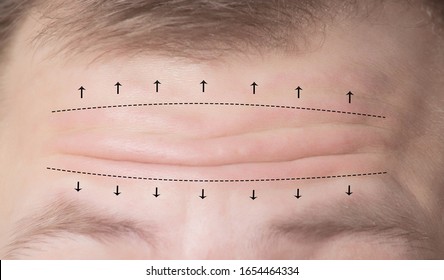 Close-up Of Male Forehead With Wrinkles And Markers For Surgery. Forehead Plastic Surgery Concept, Forehead Wrinkle Lift, Cosmetology