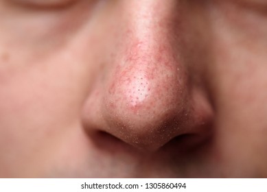 Close-up Of Male Nose With Demodicosis. Problem Skin.