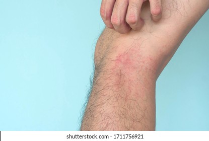 Closeup Man Hand Scratching Allergy Rash On Leg Skin, Health Care And Medical Concept