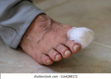 Closeup Of Man Right Foot With A Wounded Big Toe Healed With Band Aid For Medical Care. 