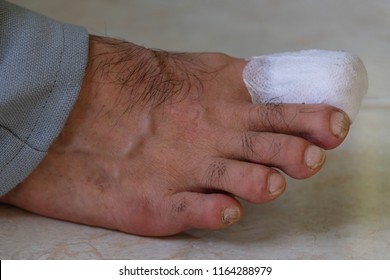 Closeup Of Man Right Foot With A Wounded Big Toe Healed With Band Aid For Medical Care. 