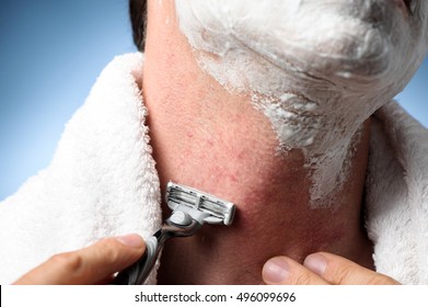 Closeup Man Shaving With Razor Burn Red Rash Bumps Shaving Cream Foam And Towel