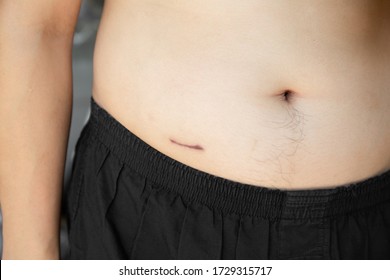 Closeup of man showing the stomach with a scar from appendicitis surgery.