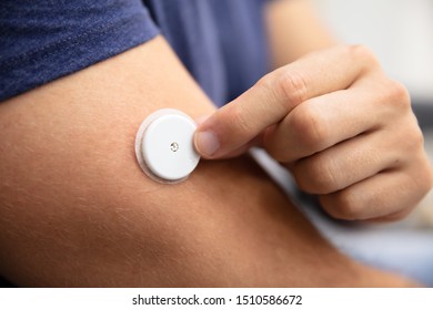 Close-up Of A Man Testing Glucose Level With A Continuous Glucose Monitor On His Arm