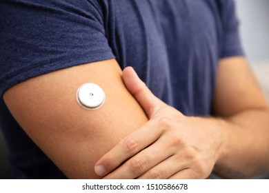 Close-up Of A Man Testing Glucose Level With A Continuous Glucose Monitor On His Arm