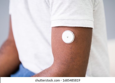 Close-up Of A Man Testing Glucose Level With A Continuous Glucose Monitor On His Arm