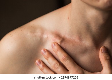 Close-up of man's collarbone injury. Black background. Injured athlete after successful fractured clavicle bone surgery and osteosynthesis of broken collarbone with titanium plate or metal clamp. - Shutterstock ID 2194997203