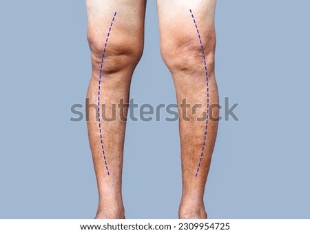 Closeup man's knees with worn legs, Knee Osteoarthritis in elder asian man, the articular cartilage becomes thin and worn causing bow legged stiffness, pain and limitation in movement.
