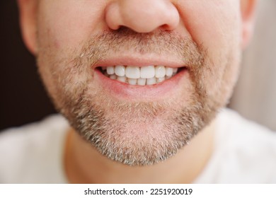close-up. the man's mouth with stubble smiles and shows white teeth. the concept of dental services, whitening and veneers. - Shutterstock ID 2251920019