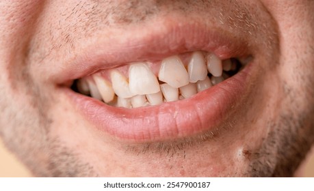 Close-up of a man's open smile with a broken tooth before a dentist appointment - Powered by Shutterstock