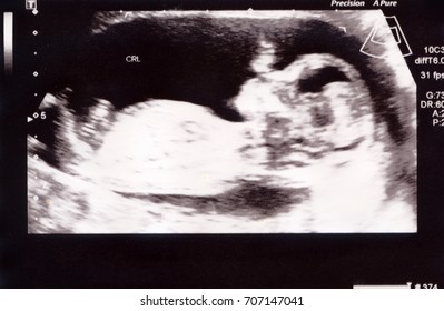 Closeup of medical ultrasound photo 