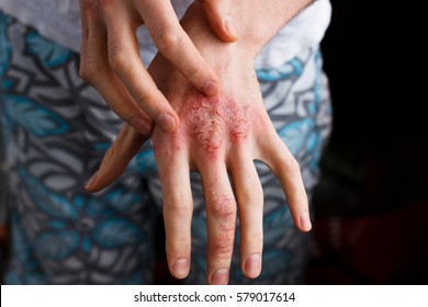 Closeup men itching and scratching by hand. Psoriasis or eczema on the hand. Atopic allergy skin with red spots