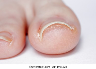 Closeup Of A Minor Case Of Pincer Nail On Young Woman’s Toe