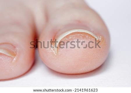 Closeup of a minor case of Pincer Nail on young woman’s toe