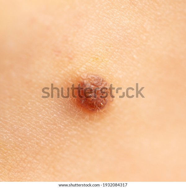 Close-up of a mole on\
human skin. Marco