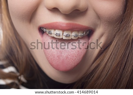 Closeup of a mouth with braces on theeth and the tongue out, isolated in white
