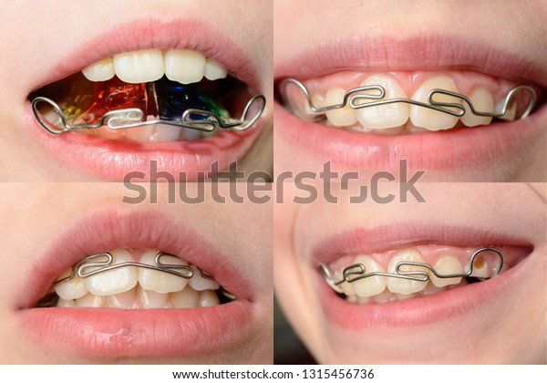 Close-up mouth of crooked teeth with braces\
Toothbrush in the mouth of the\
adolescent