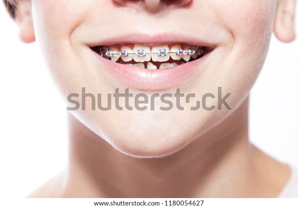 Closeup Mouth Dental Corrector Braces Stock Photo Edit Now